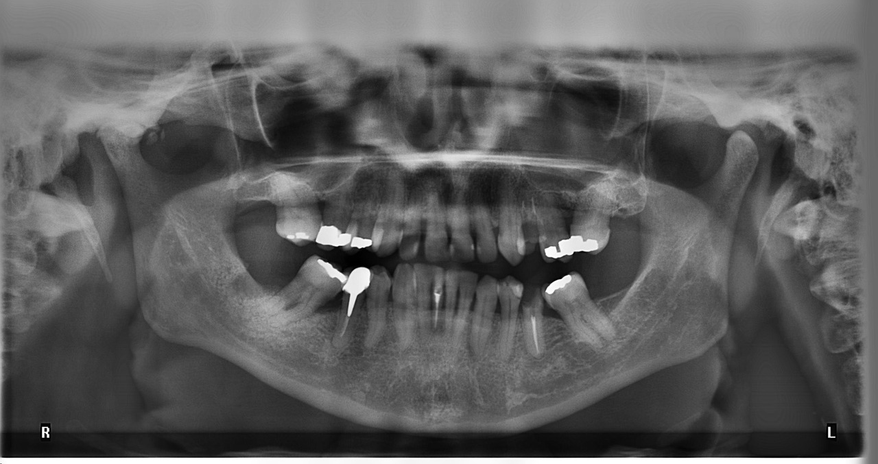 X-ray/radiograph of a panoramic view of the teeth with some fillings in it