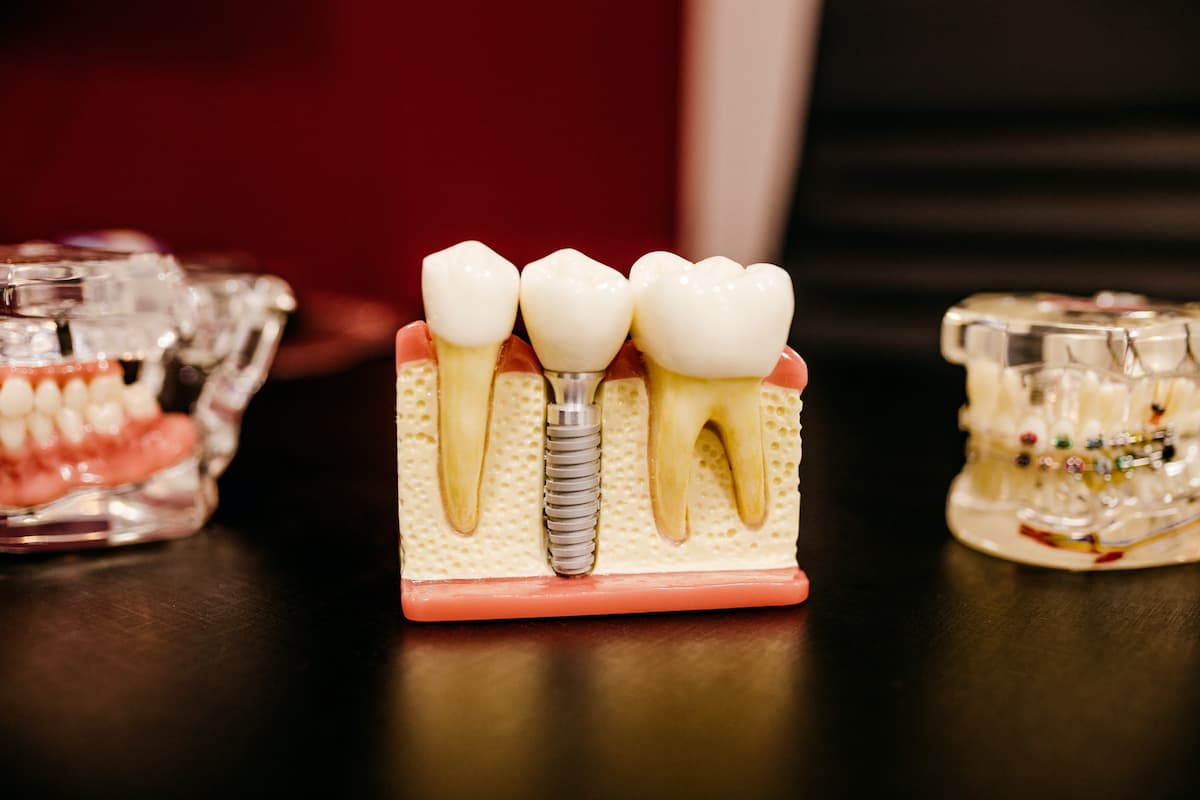 A plastic model of a dental implant between two standard teeth, with the gum cross sected